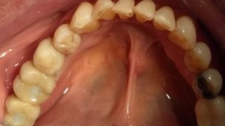 Geoff - Dental Implants after