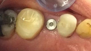 Catherine - Dental Implants before