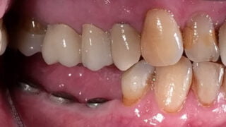 Colin - Dental Implants before